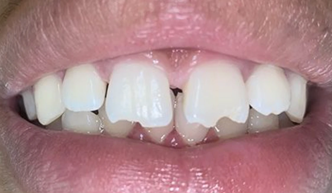 Chipped Tooth Repair — before
